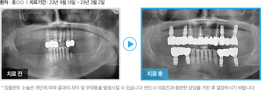 수면임플란트 증례1