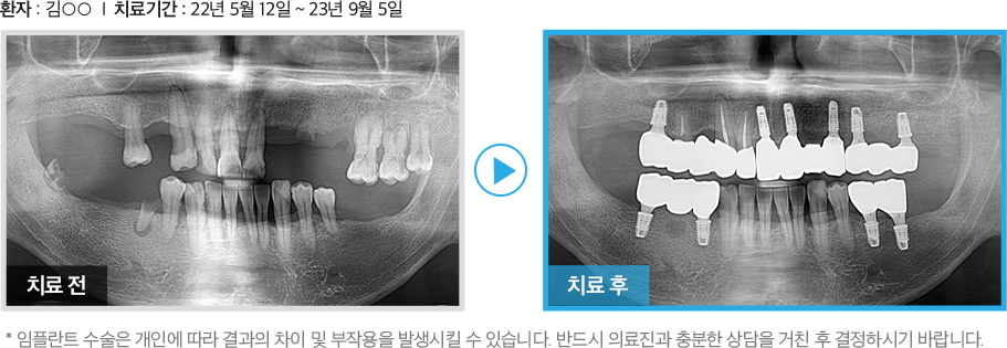 수면임플란트 증례2