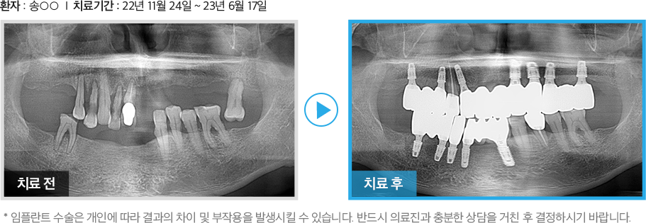 컴퓨터분석 임플란트 증례1