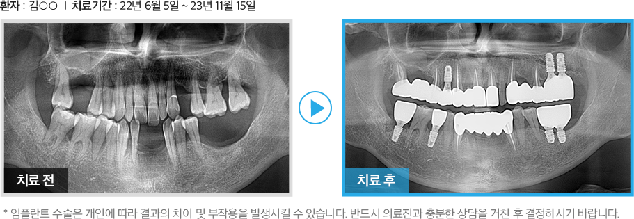 컴퓨터분석 임플란트 증례2