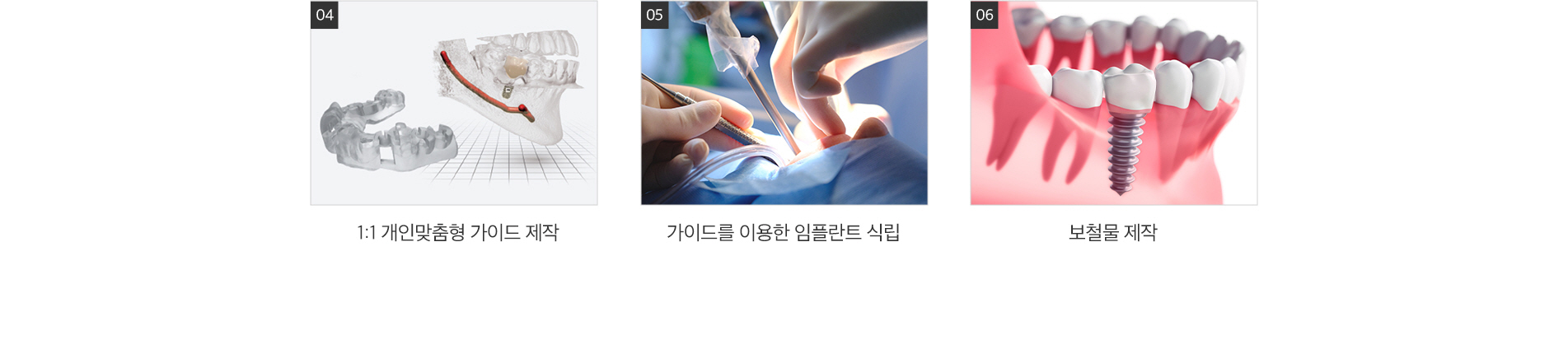 컴퓨터 분석 임플란트