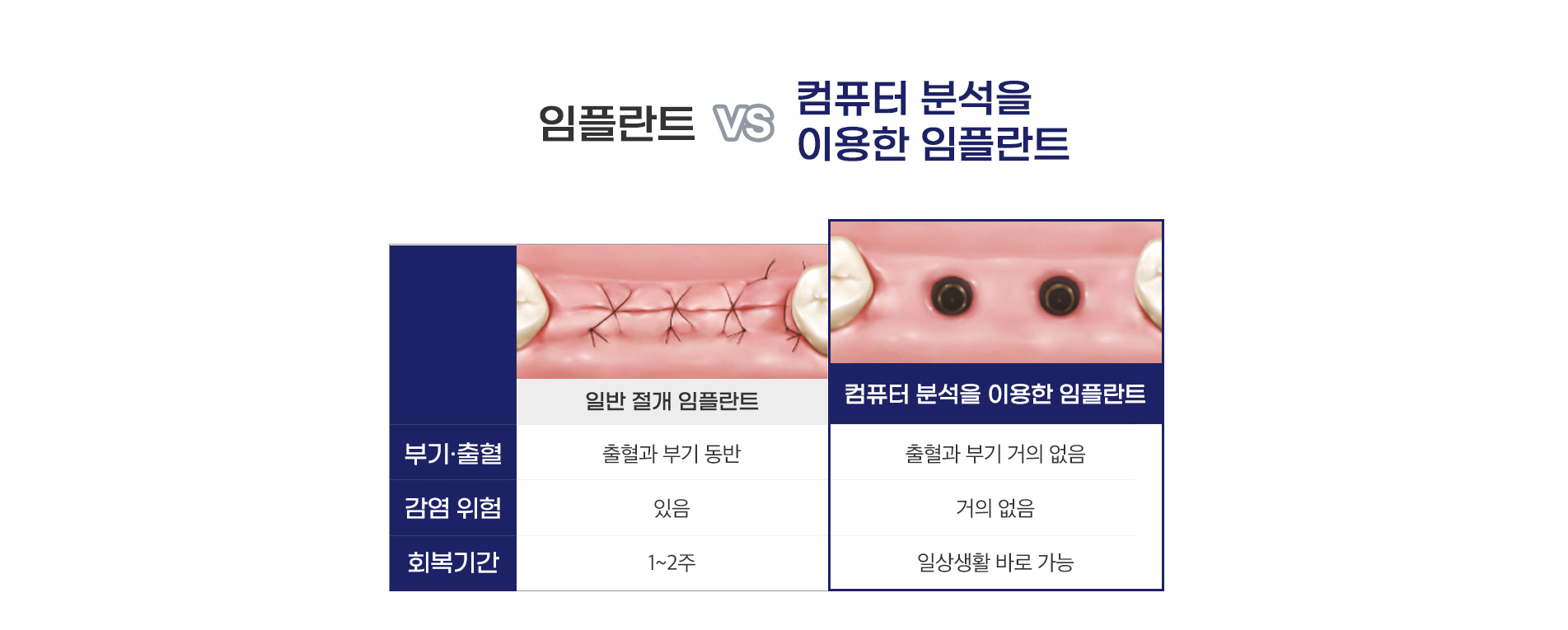 임플란트 vs 컴퓨터 분석 임플란트