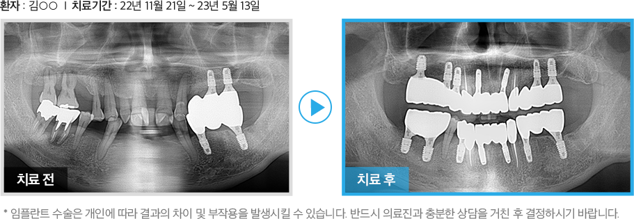 고난도 수술 증례