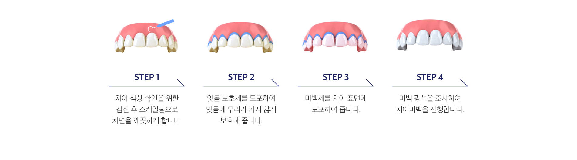 전문가 치아미백 과정