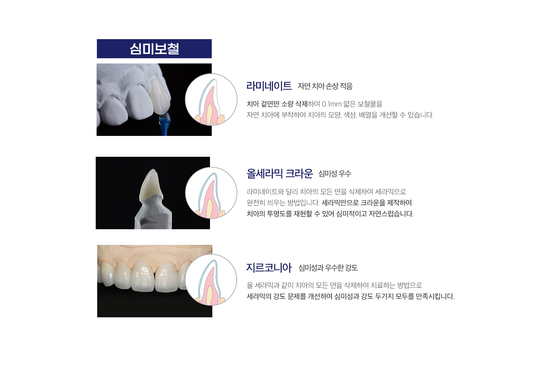 라미네이트, 올세라믹 크라운, 지르코니아