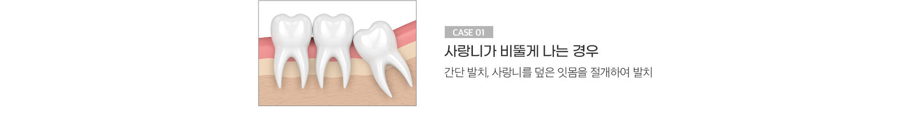 사랑니가 비뚤게 나는 경우