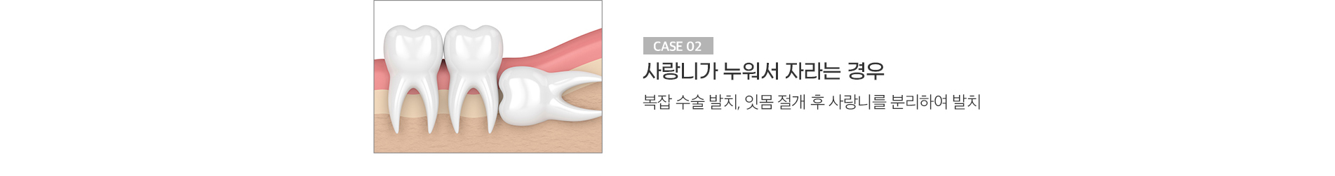 사랑니가 누워서 자라는 경우