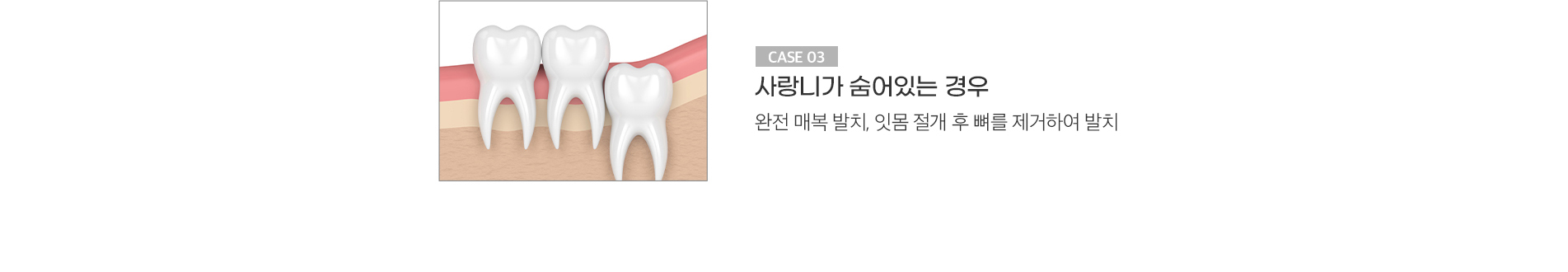 사랑니가 숨어있는 경우