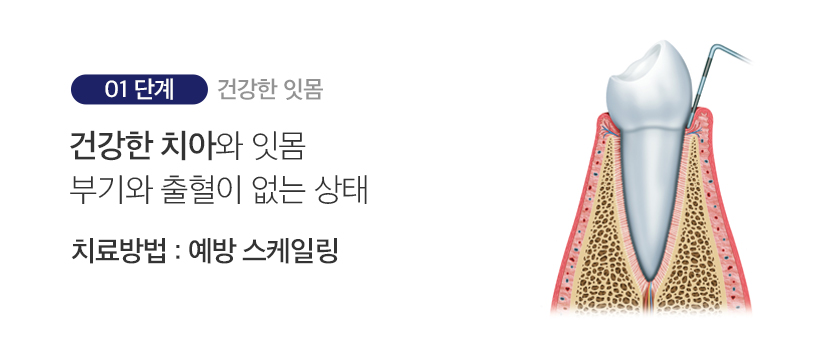 1단계 건강한 잇몸
