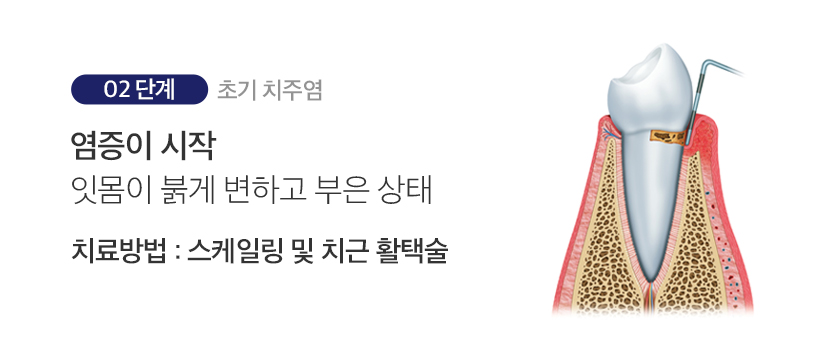 2단계 초기 치주염