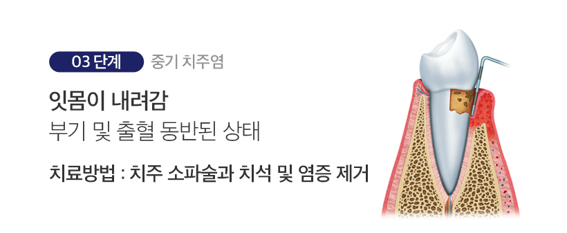 3단계 중기 치주염