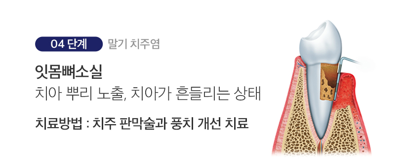 4단계 말기 치주염