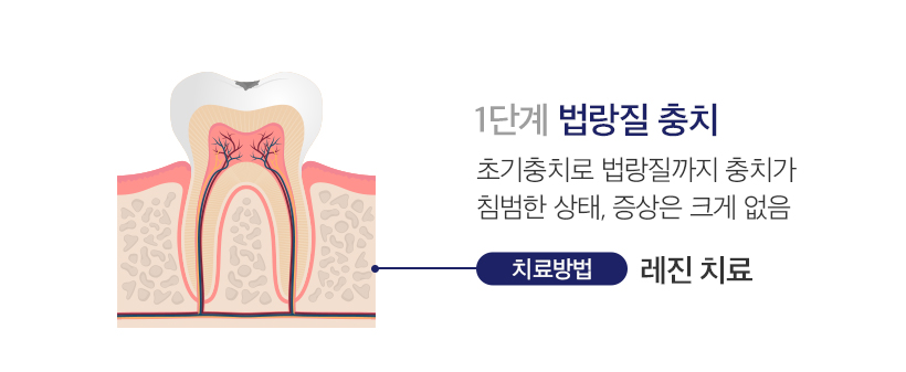 1단계 법랑질 충치