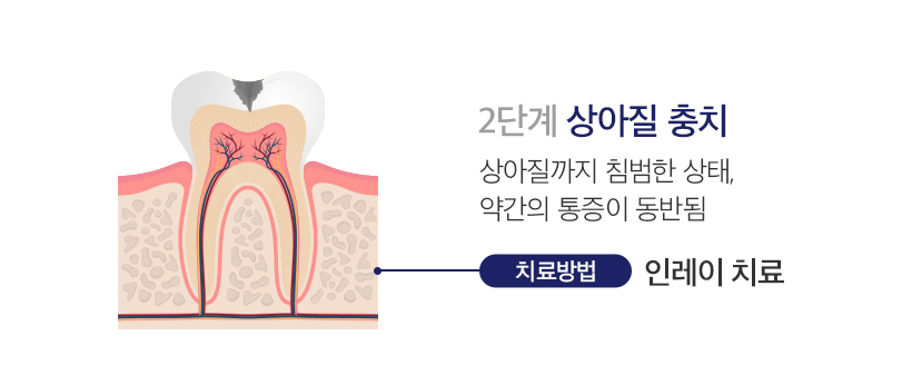 2단계 상아질 충치