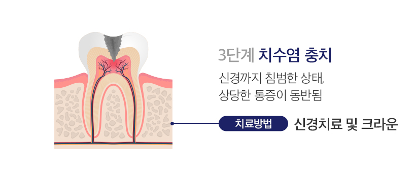3단계 치수염 충치