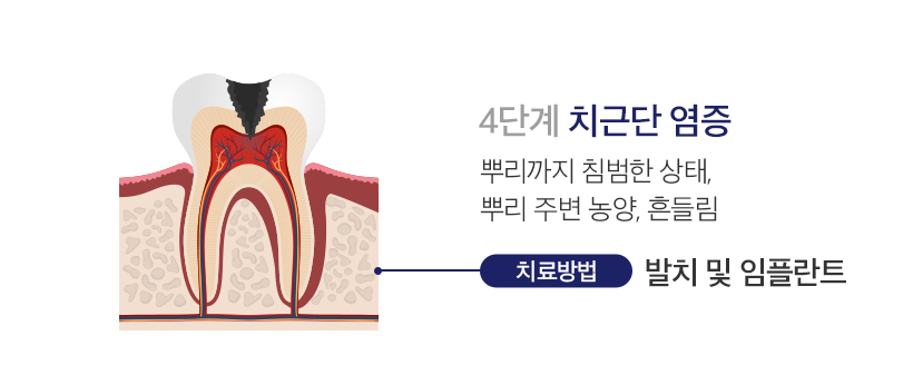 4단계 치근단 충치