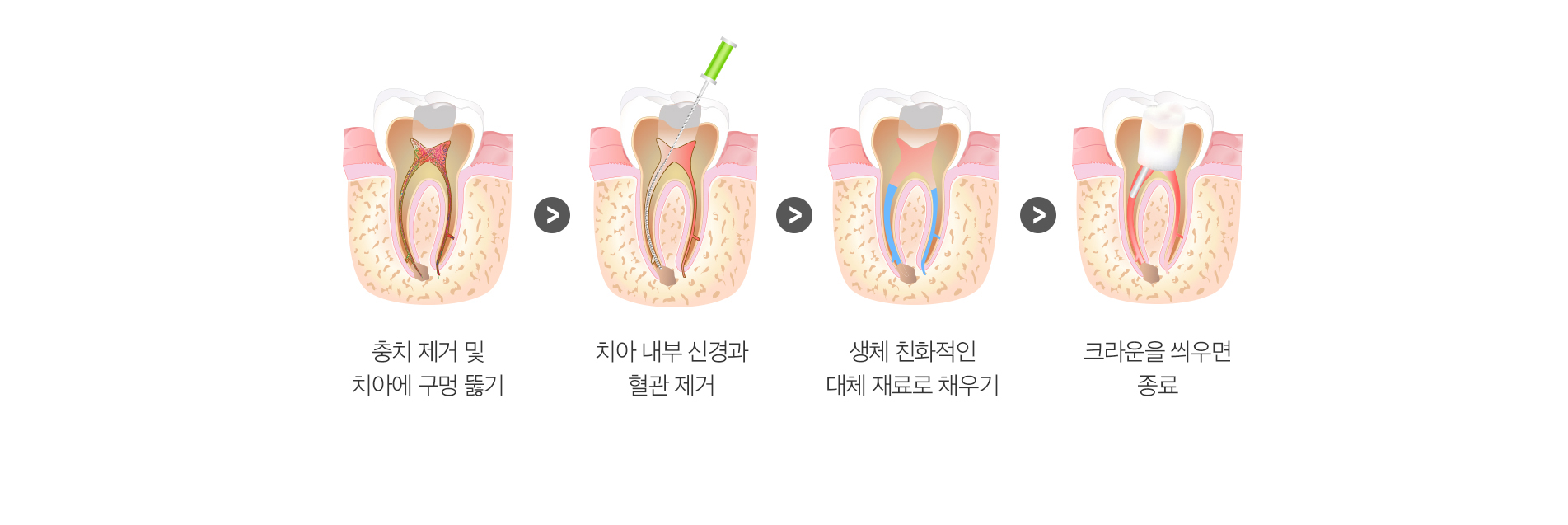 신경치료 단계별 치료과정